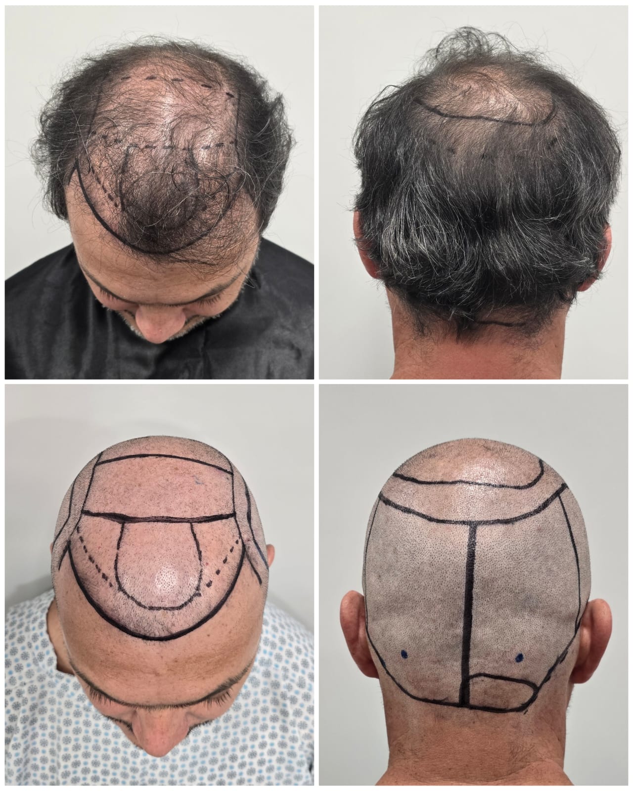 vantagens transplante capilar fue
