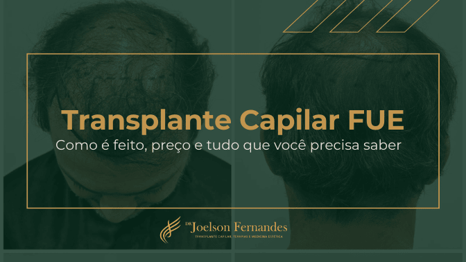 transplante capilar fue