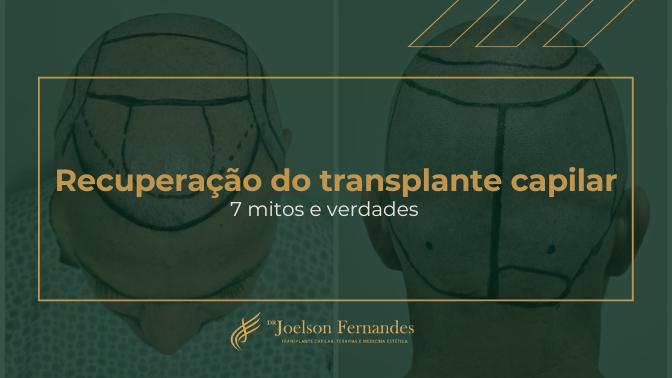 Recuperação do transplante capilar 7 mitos e verdades